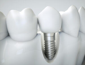 Close up of dental implant in West Orange